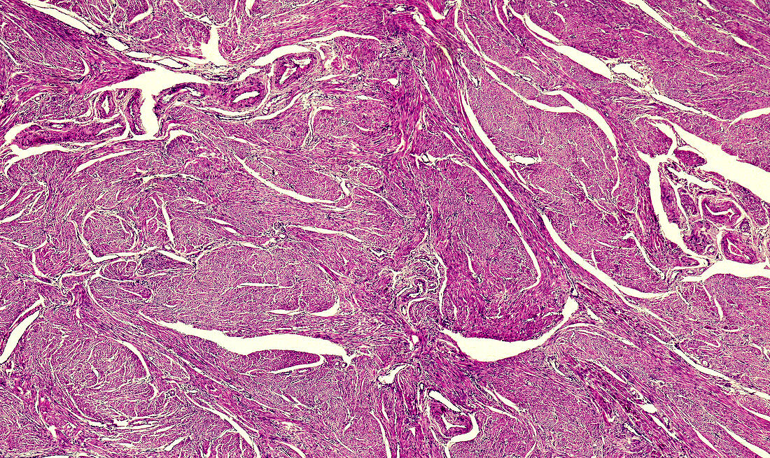 Uterine adenomyosis, light micrograph