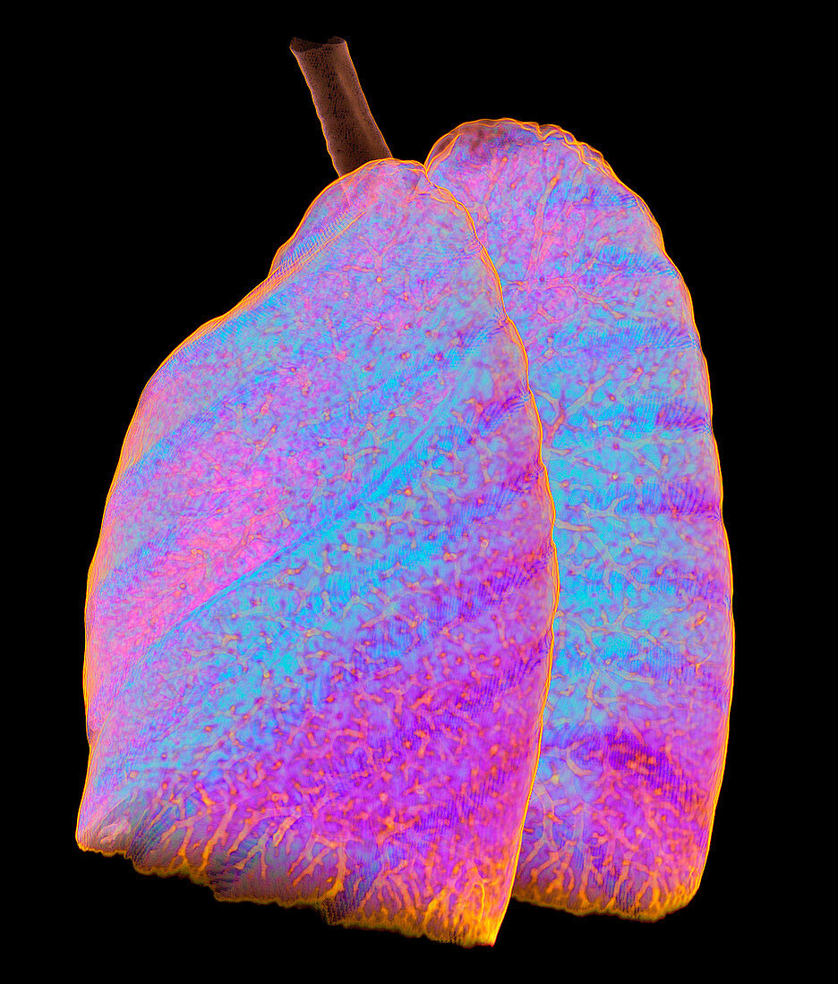 Aeration pattern in healthy lungs, 3D CT scan