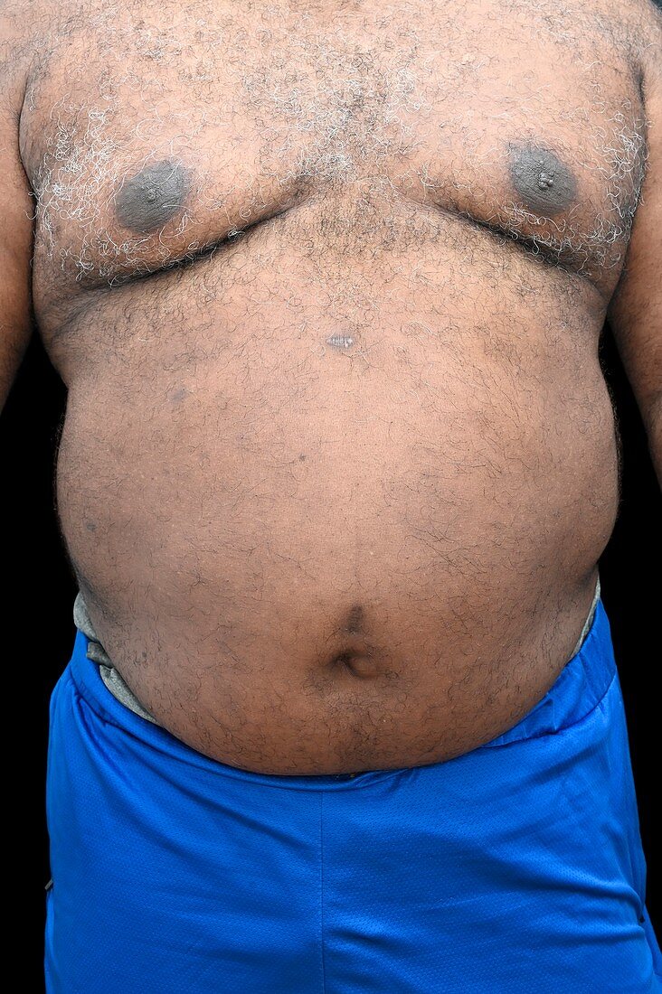 Overweight man's abdomen