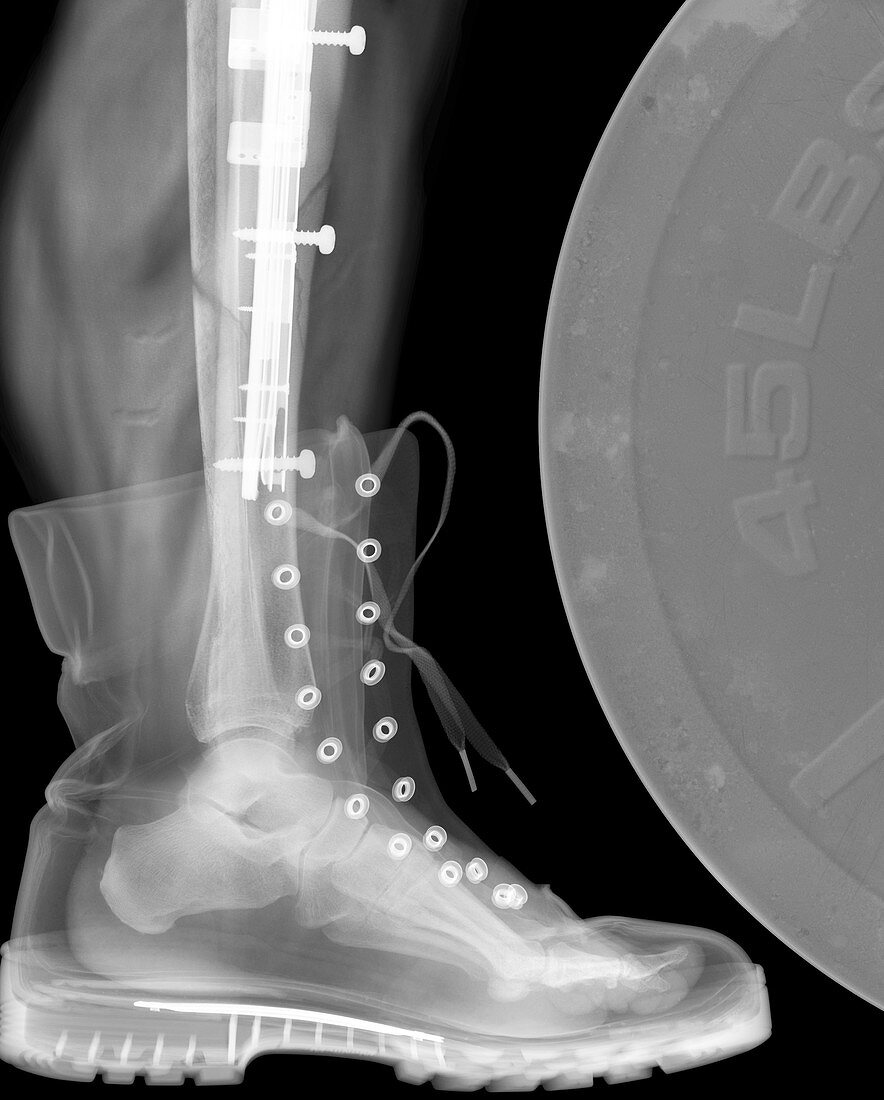 Broken leg, X-ray