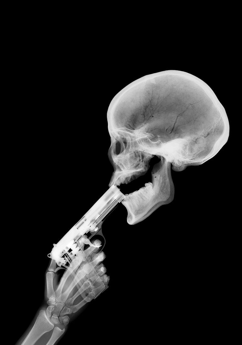 Gun and skeleton, X-ray