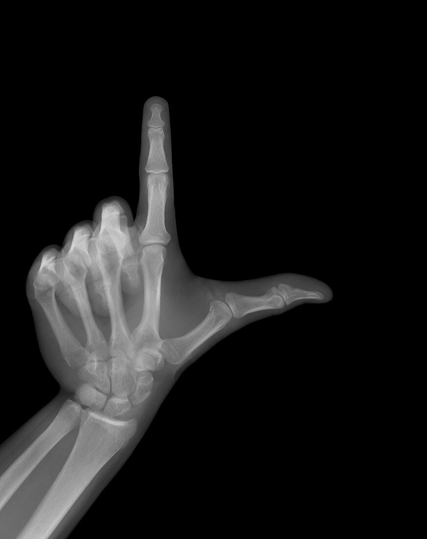 Hand sign, X-ray