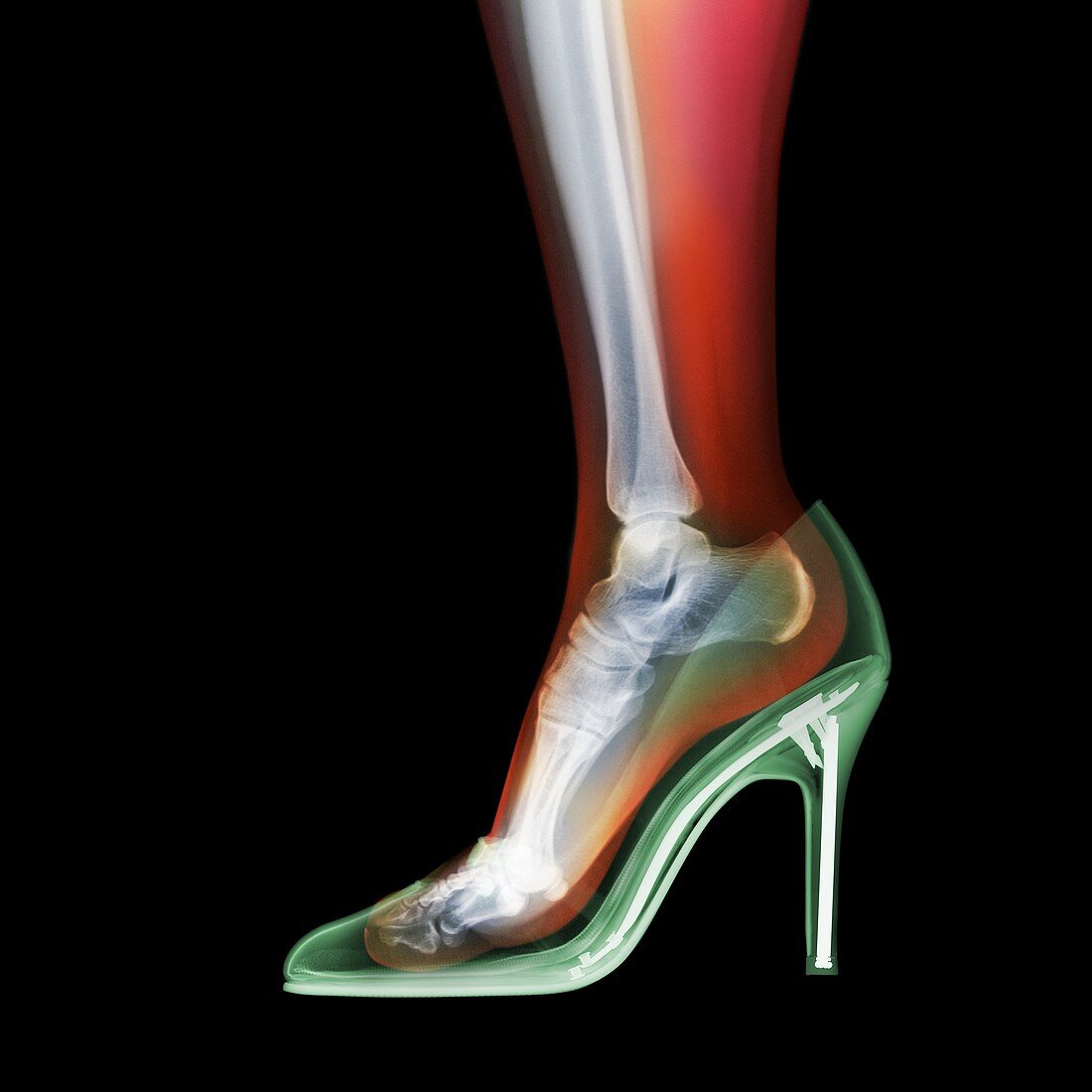 Human leg and stiletto shoe, X-ray
