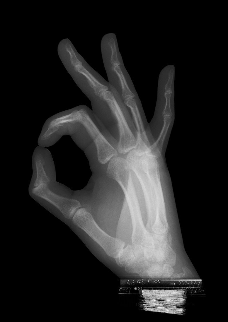 OK hand gesture, X-ray