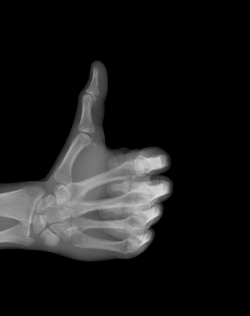 Thumbs up hands gesture, X-ray
