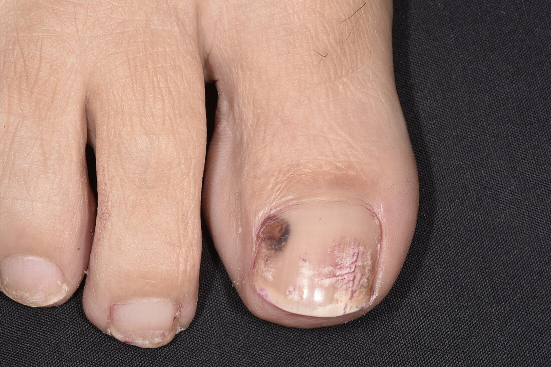 Bruised toenail