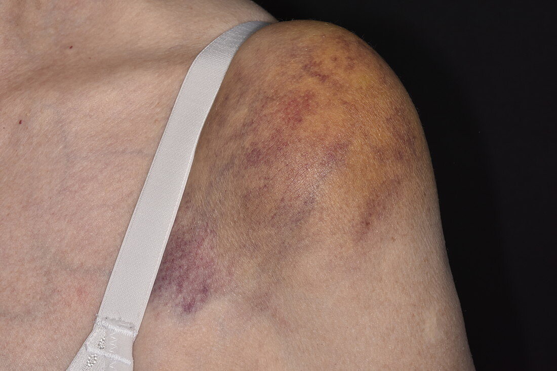 Bruised shoulder
