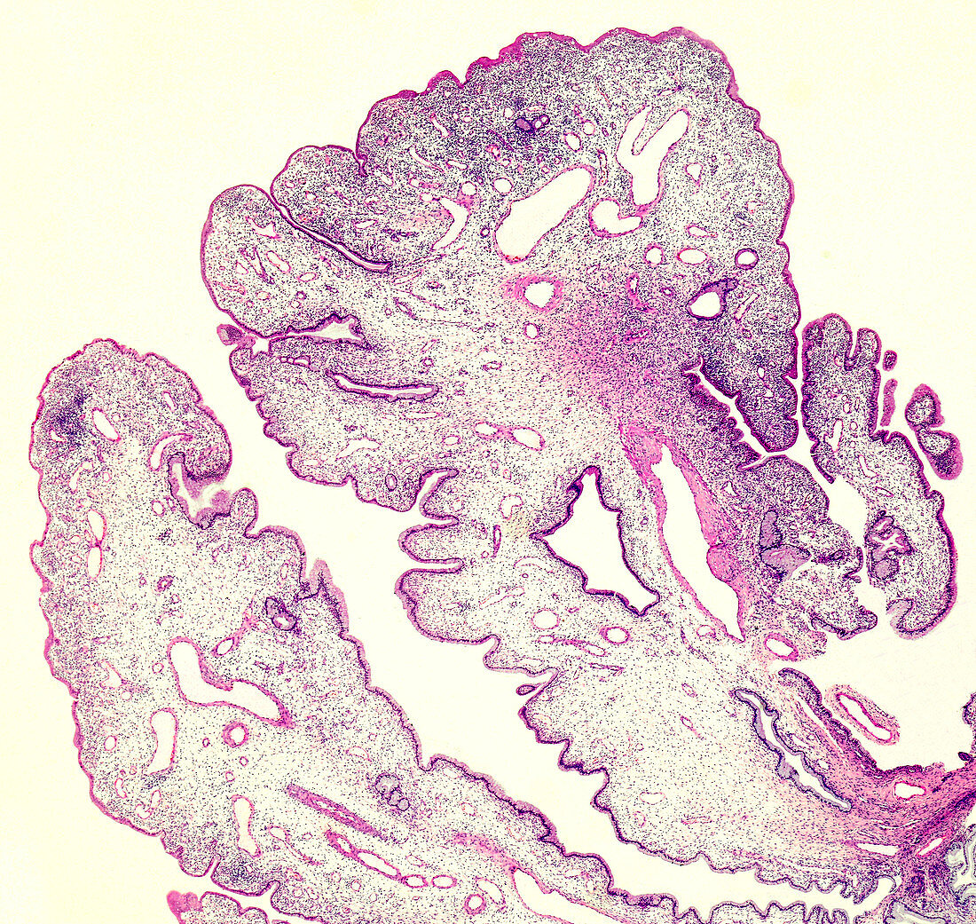 Human cervical polyp, light micrograph