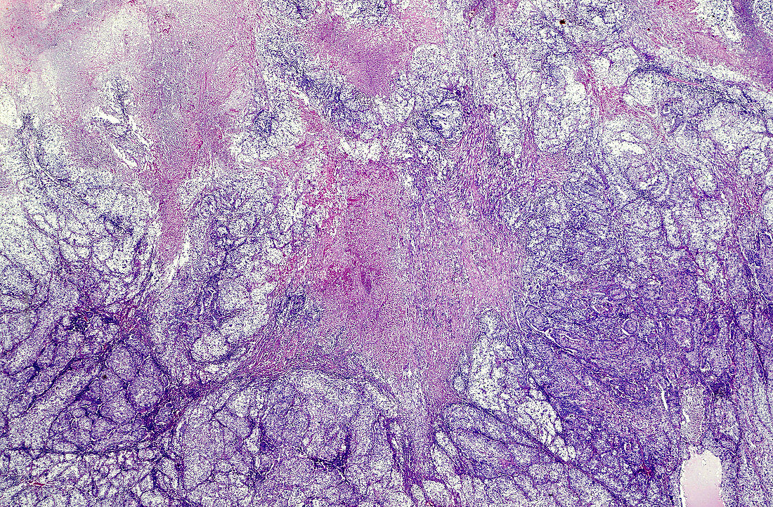Endodermal sinus tumour, light micrograph