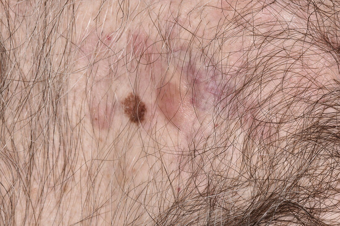 Dermatofibrosarcoma protuberans