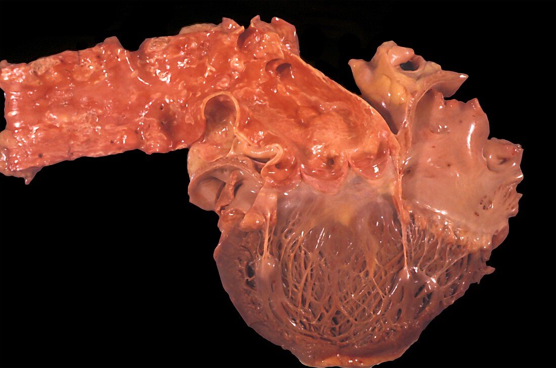 Atheromatous plaques in the aorta