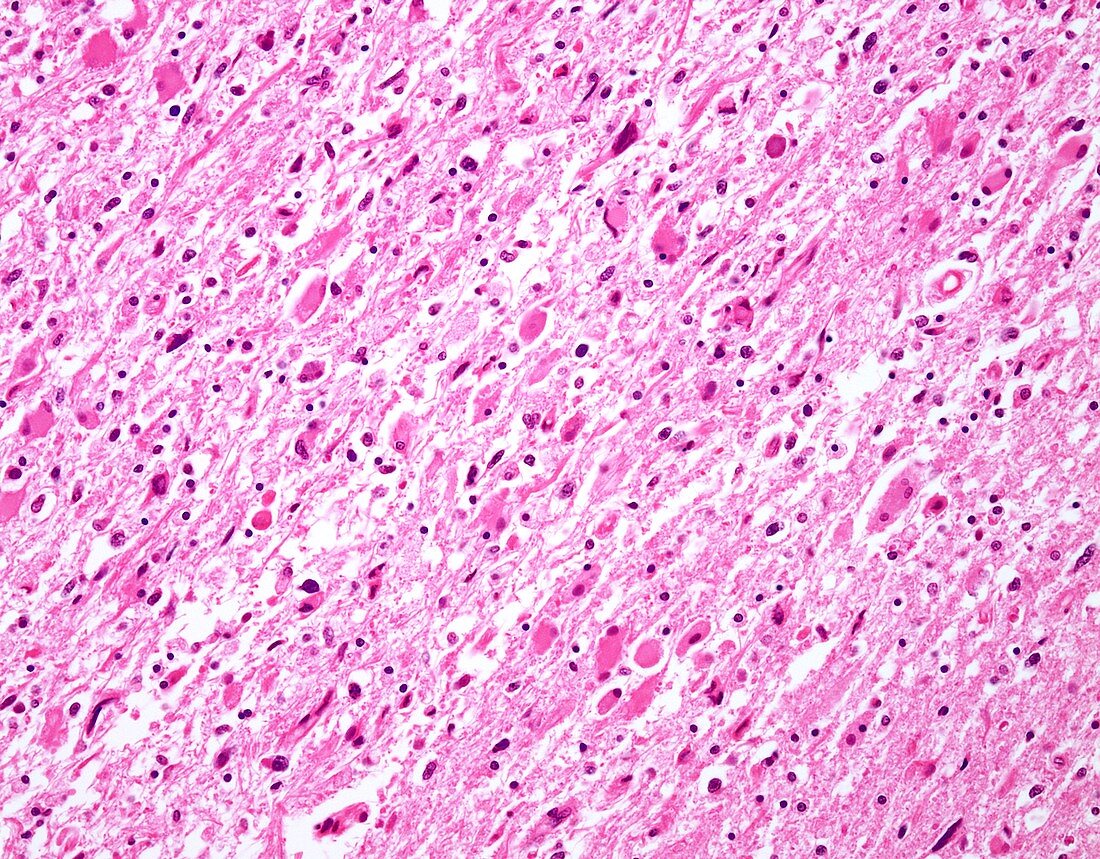 Diffuse astrocytoma, light micrograph