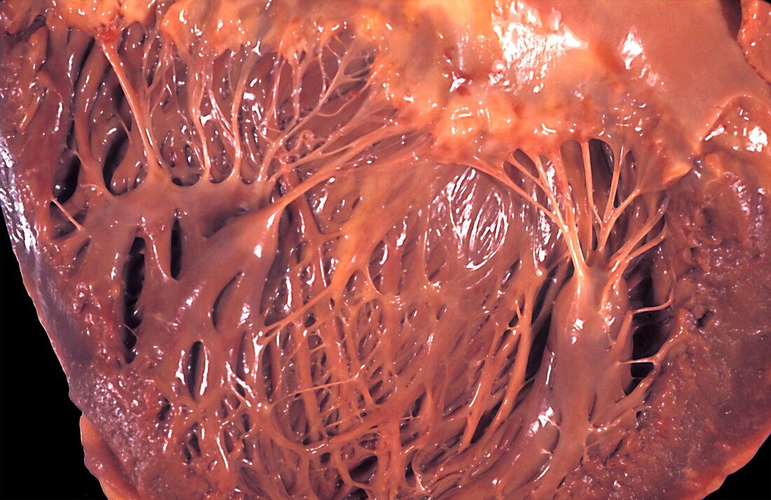 Papillary muscles in a human heart