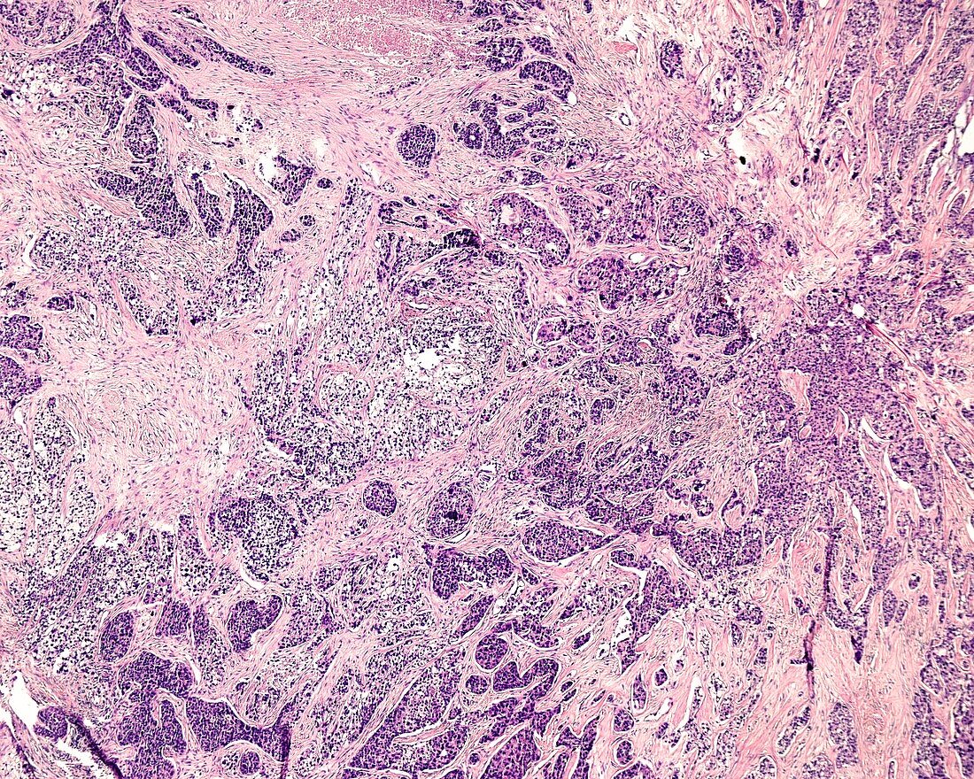 Invasive ductal carcinoma, light micrograph