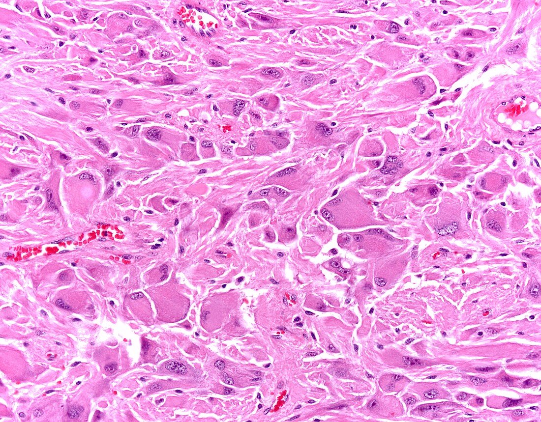 Subependymal giant cell astrocytoma, light micrograph