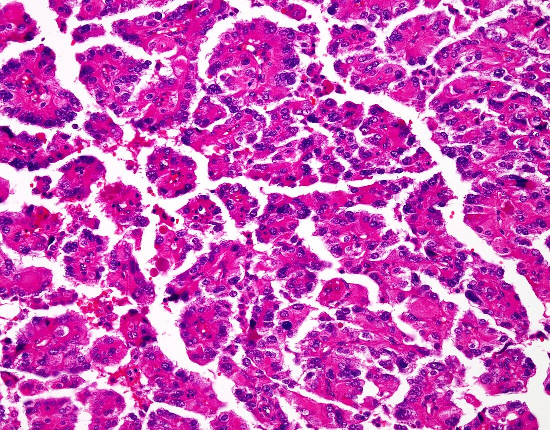 Choroid plexus carcinoma, light micrograph