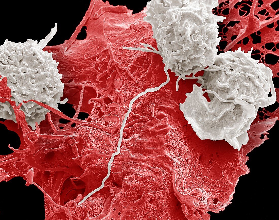 Natural killercells and cancer cell, SEM