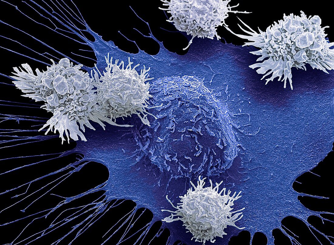 T-cells and breast cancer cell.