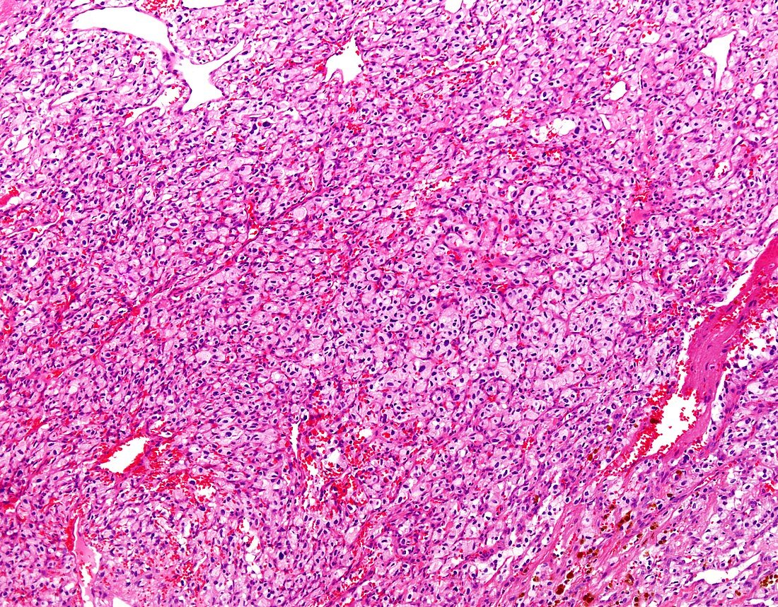 Haemangioblastoma, light micrograph