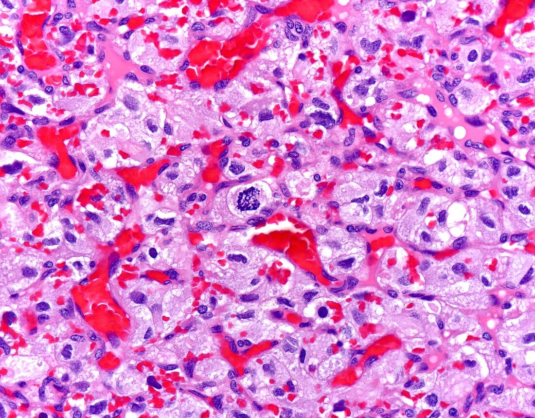 Haemangioblastoma, light micrograph