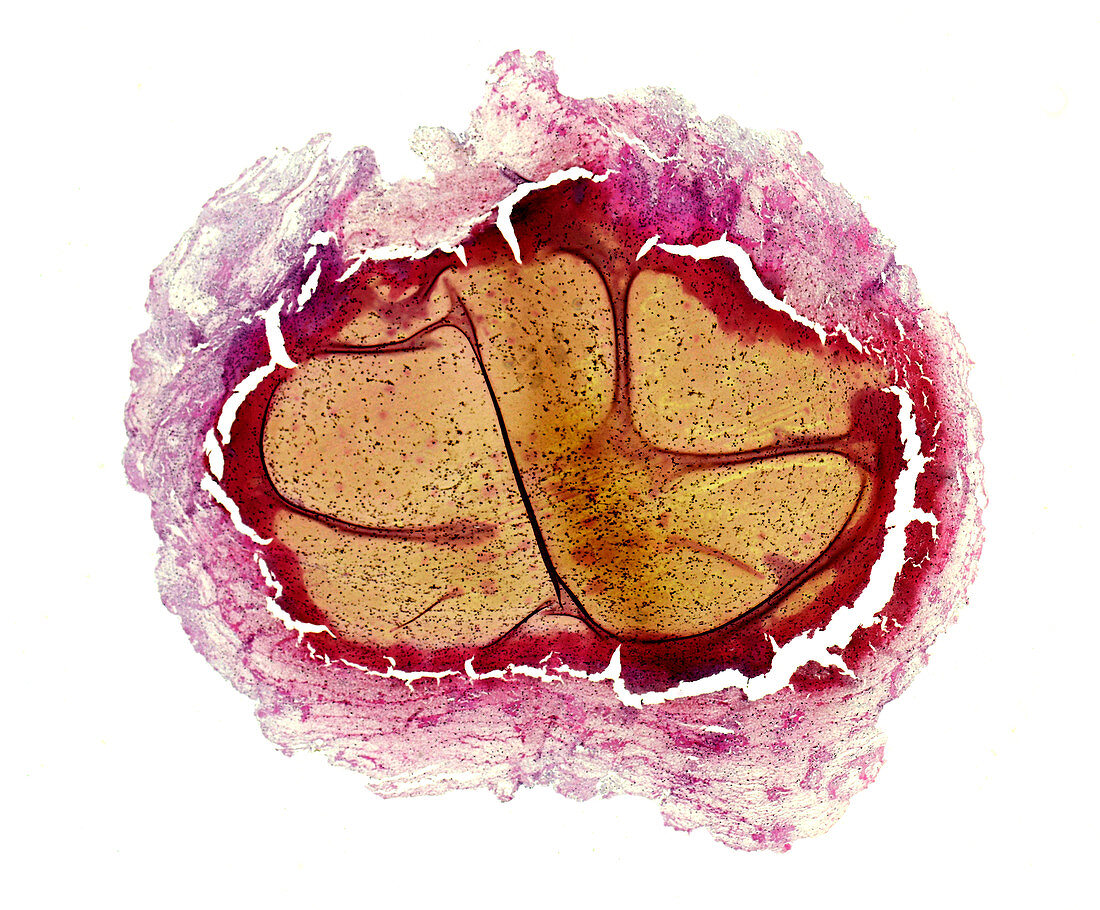Venous thrombosis, light micrograph