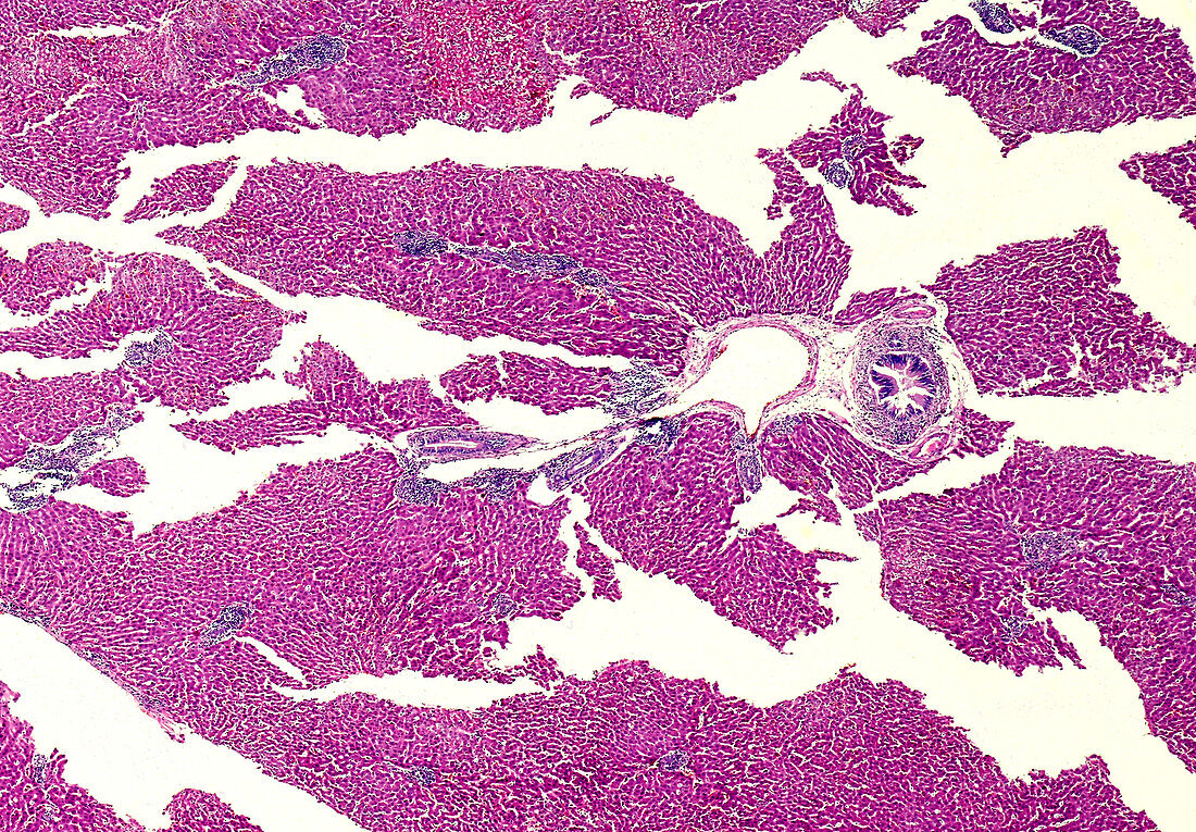 Liver abscess, light micrograph