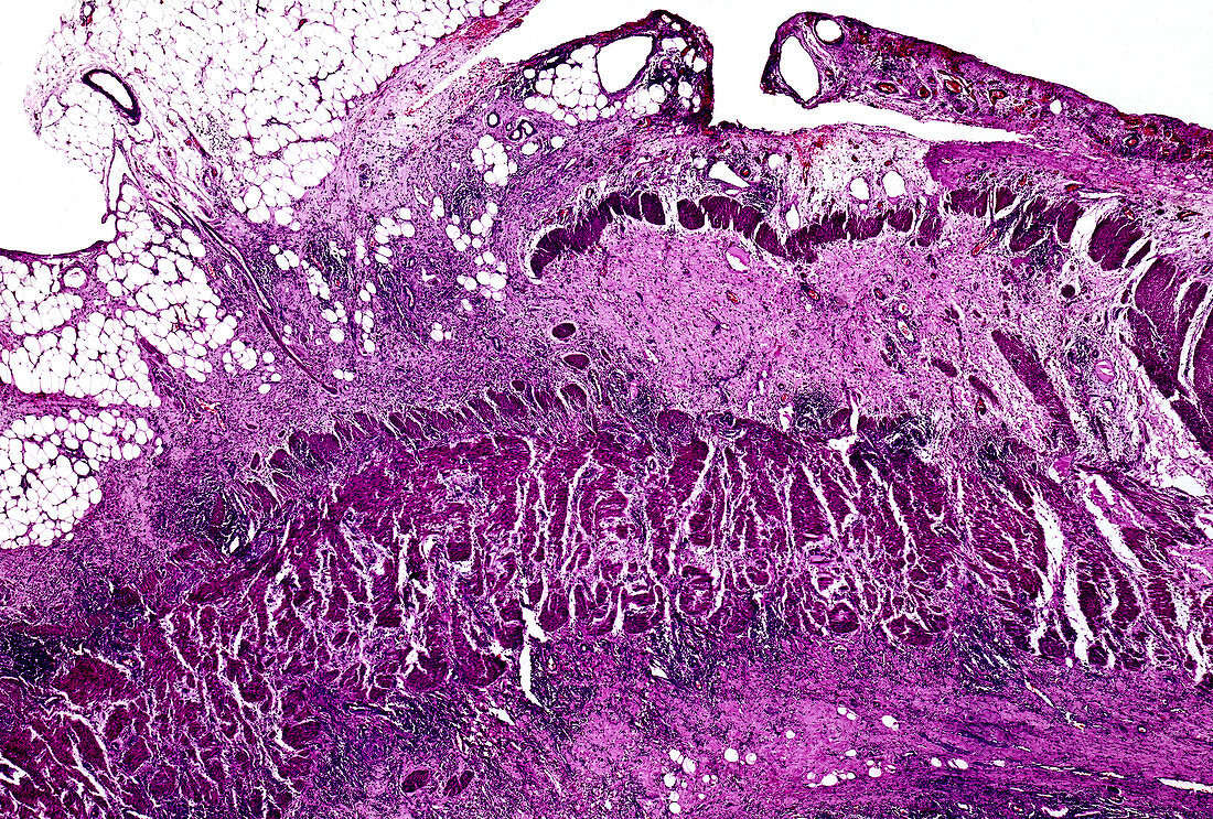 Crohn's disease, light micrograph