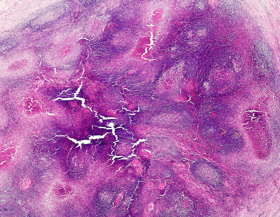 Malignant lymphoma, light micrograph