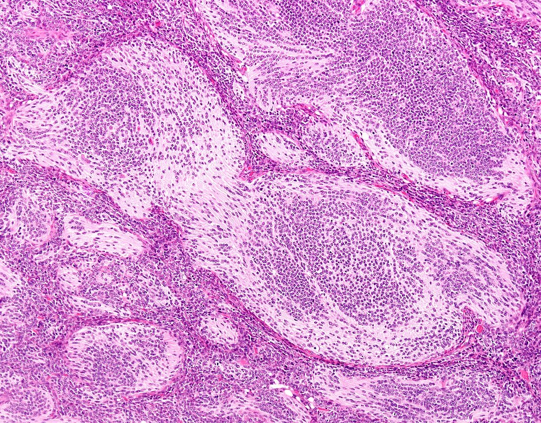 Medulloblastoma, light micrograph