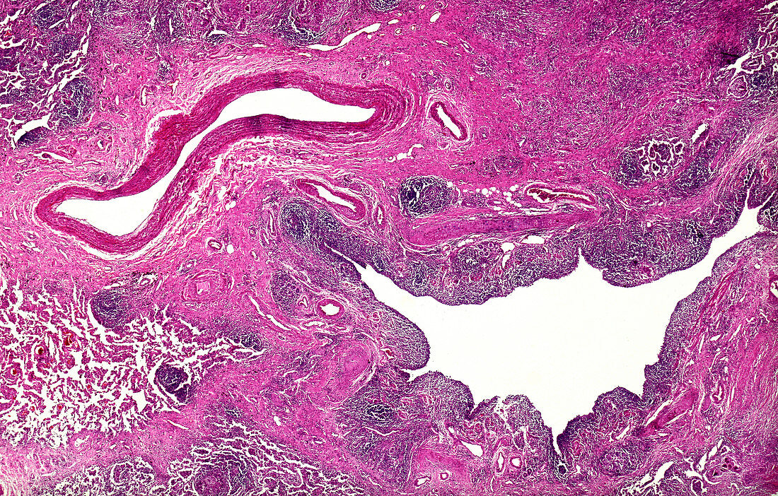 Adenosquamous carcinoma of the lung, light micrograph