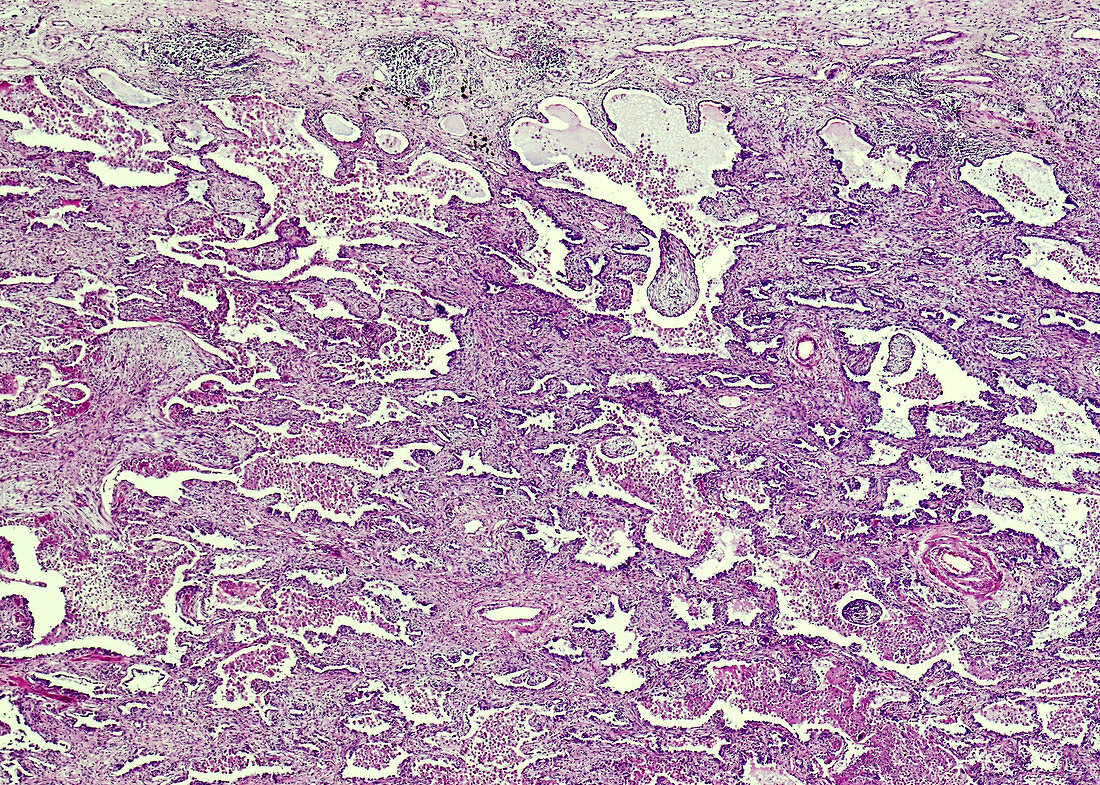 Small cell lung cancer, light micrograph