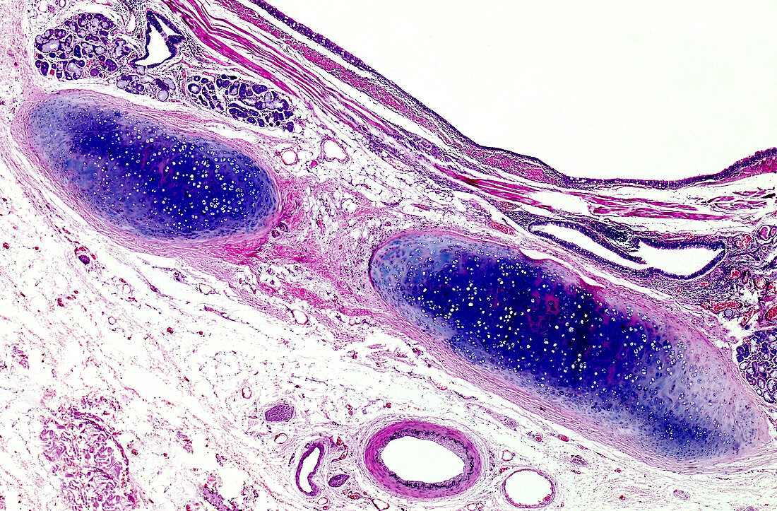 Squamous metaplasia of the lung, light micrograph