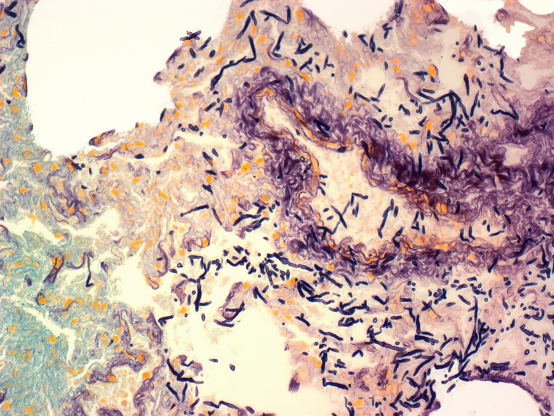 Lung fungal infection, LM