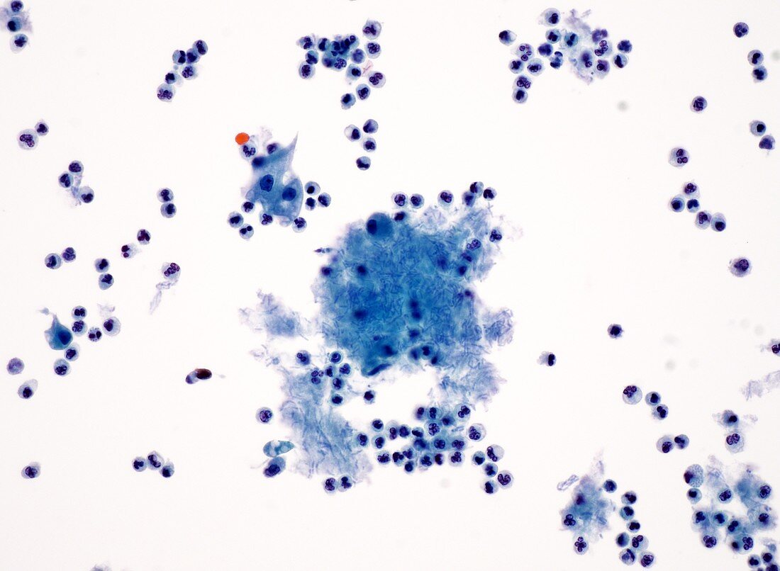 Bacteria in urine, light micrograph