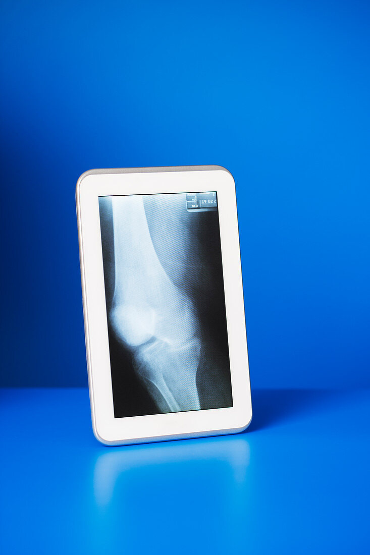 Digital tablet displaying x-ray
