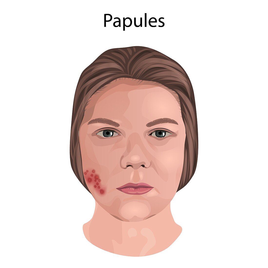 Papules, illustration