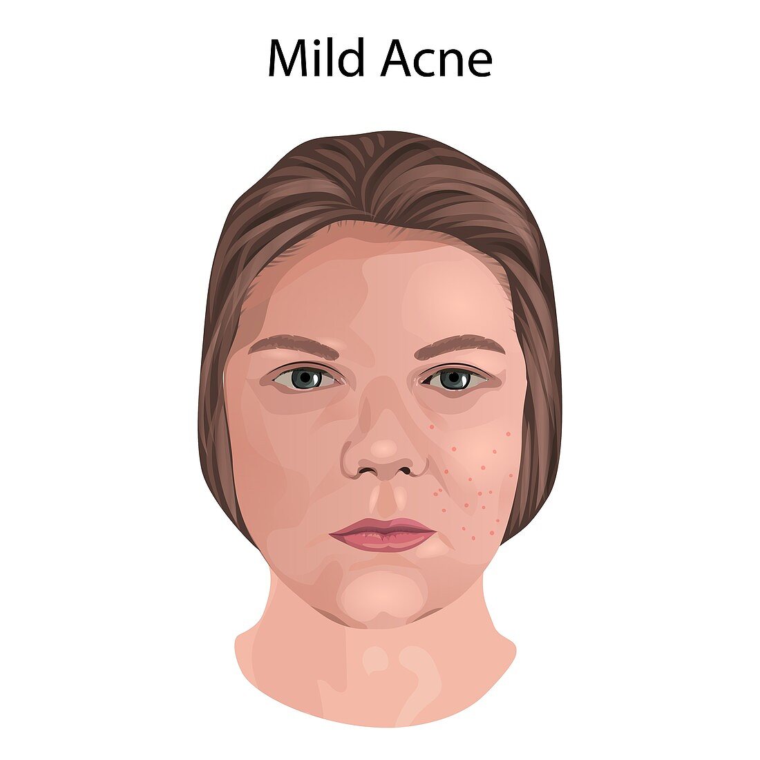 Mild acne, illustration