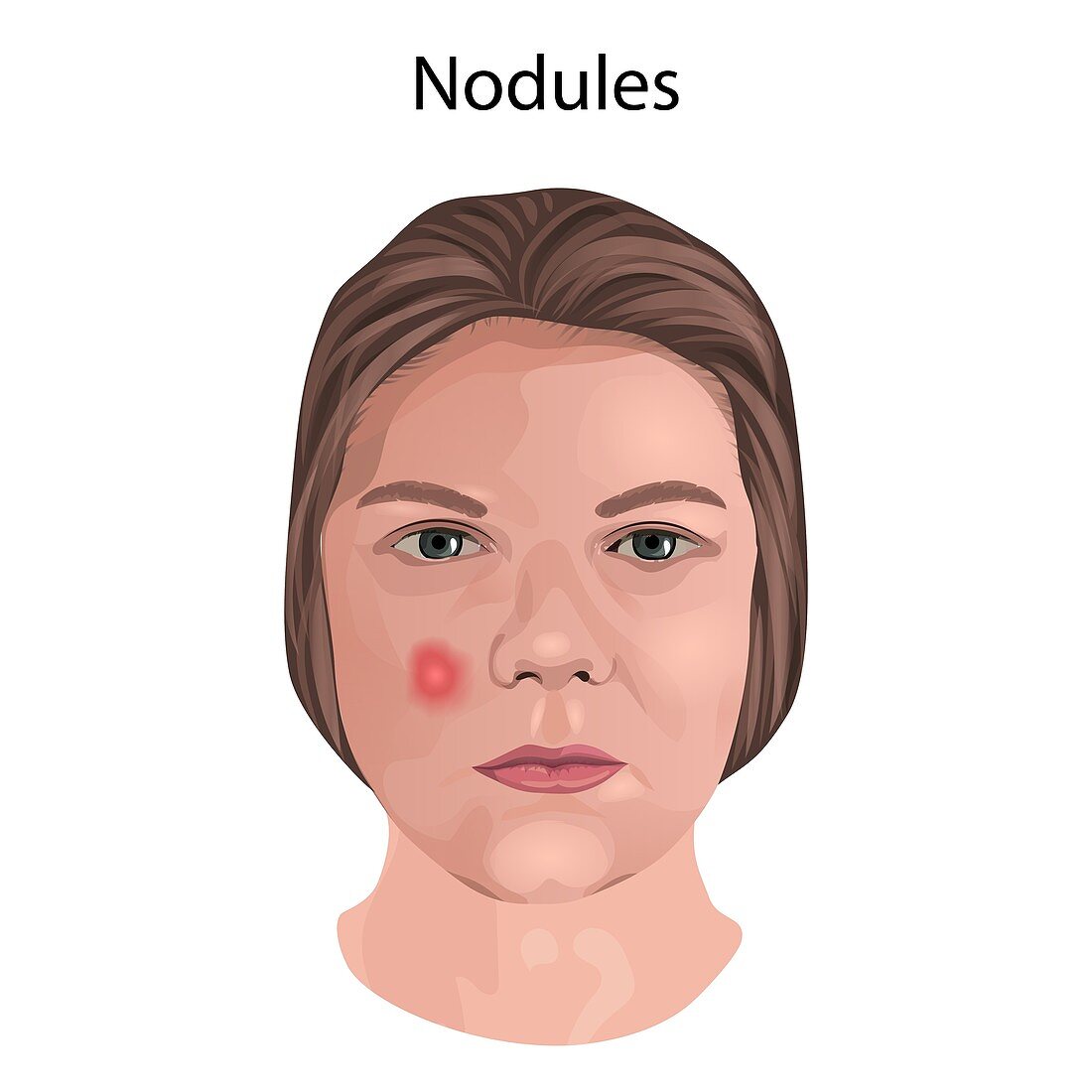 Nodules, illustration