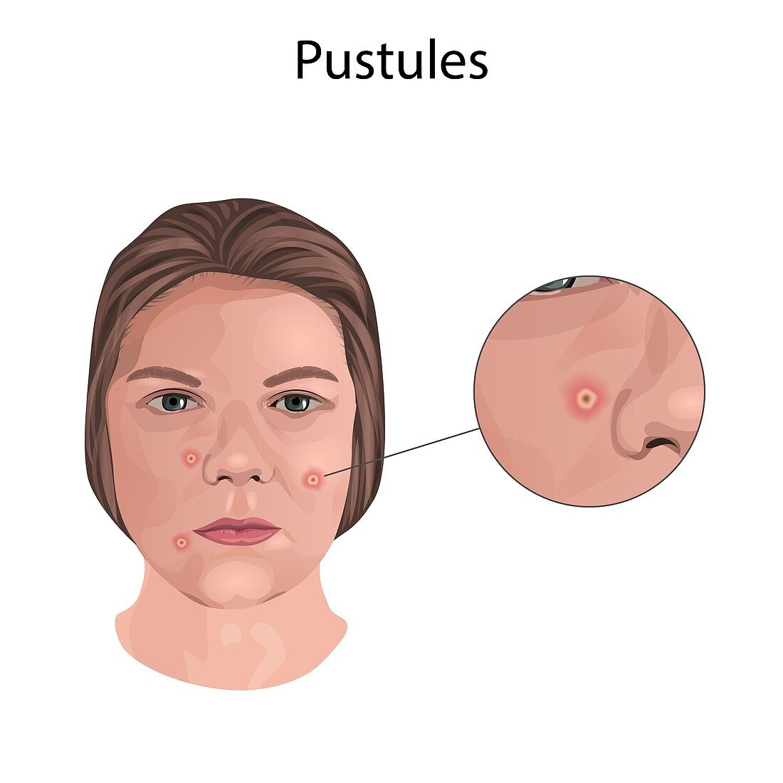 Pustules, illustration