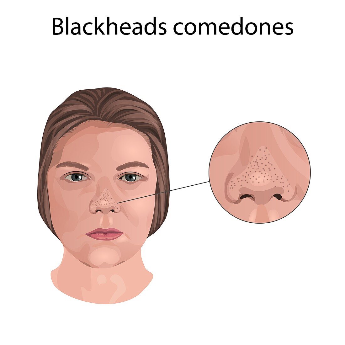 Blackhead comedones, illustration