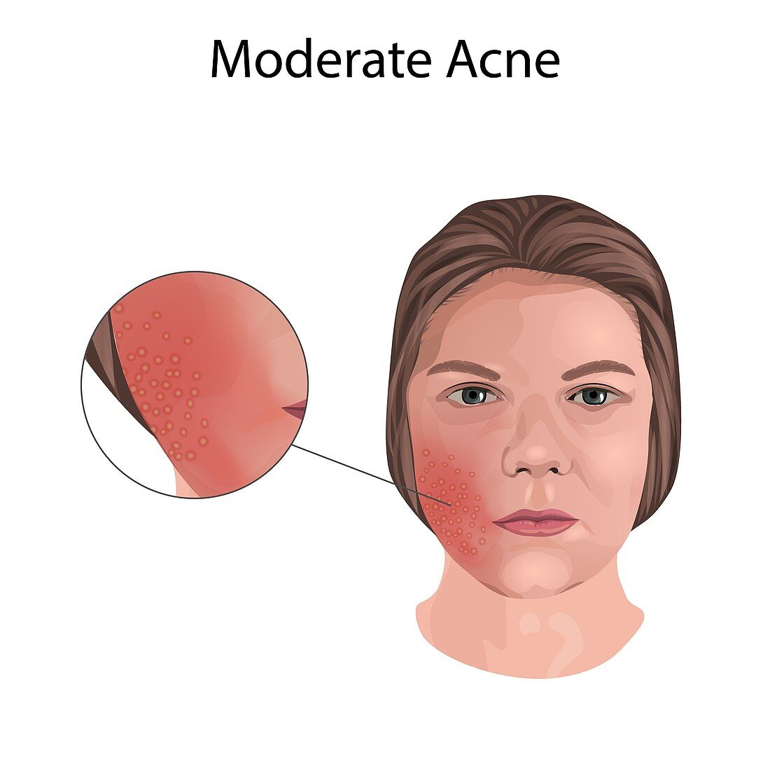 Moderate acne, illustration