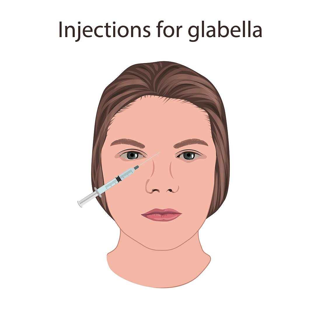 Injections for glabella, illustration