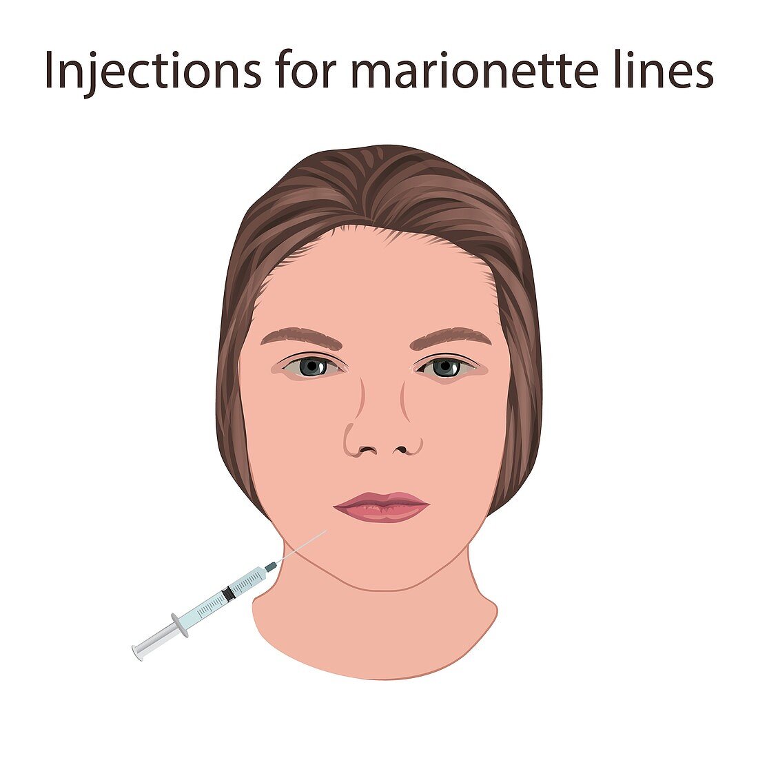 Injections for marionette lines, illustration