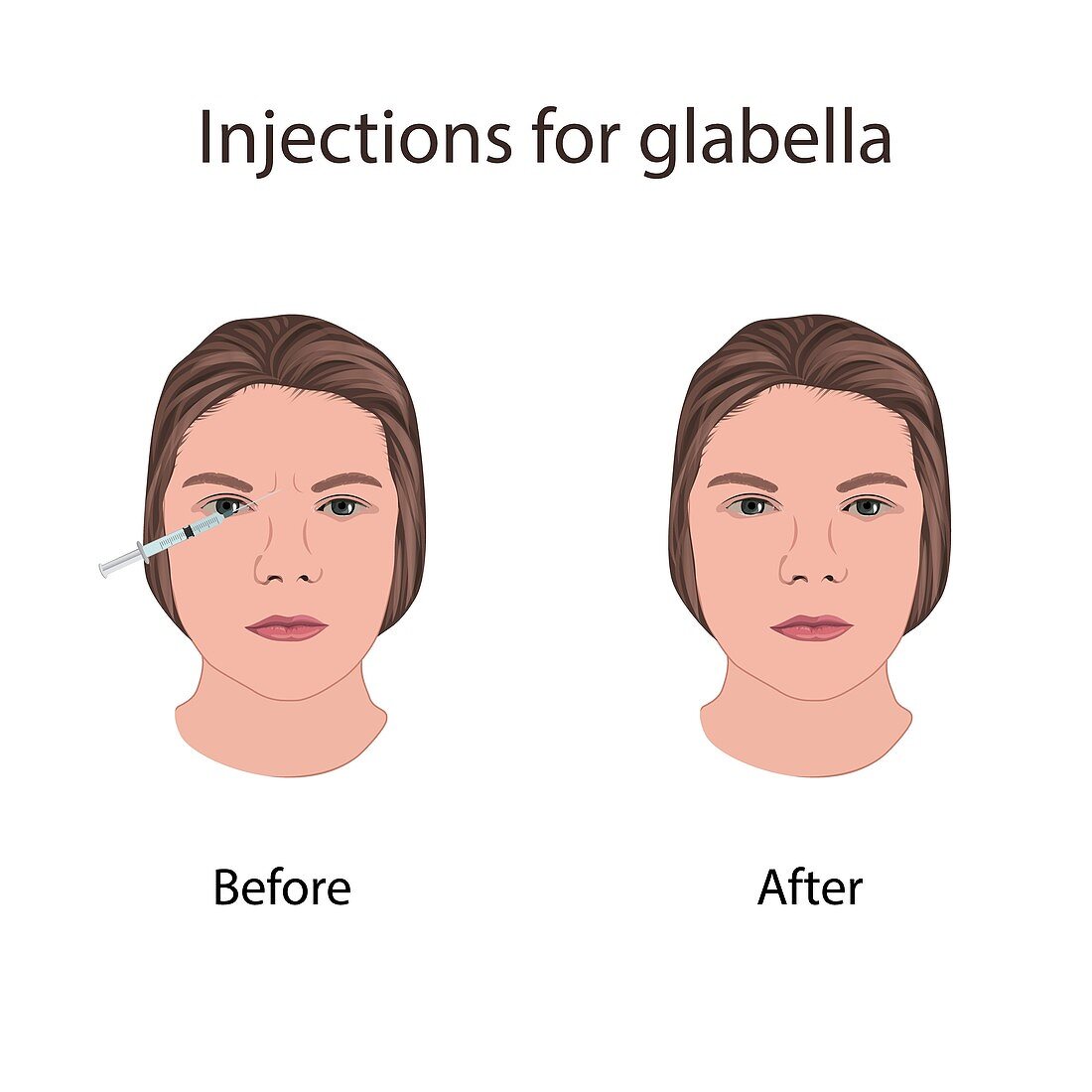 Injections for glabella, illustration