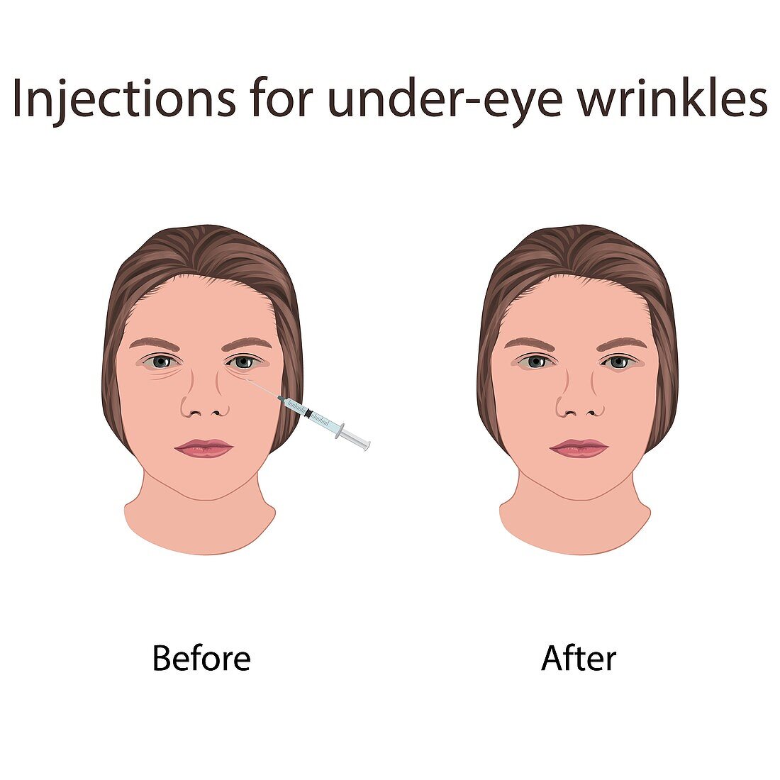 Injections for under-eye wrinkles, illustration