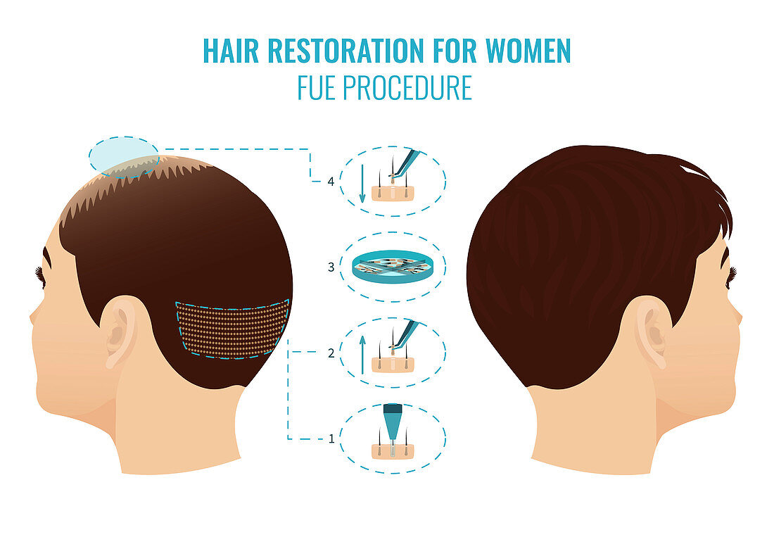 FUE hair loss treatment in women, illustration