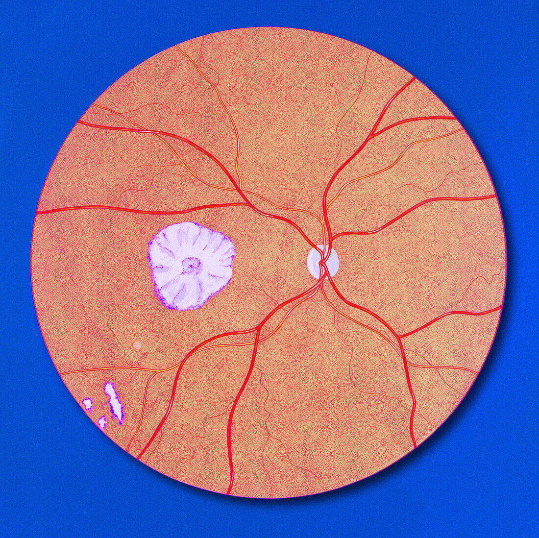 Fundoscopic view of CMV retinitis, illustration