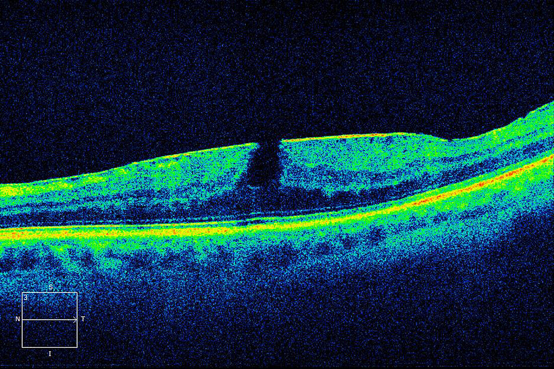 Macular pucker with lamellar hole, OCT scan