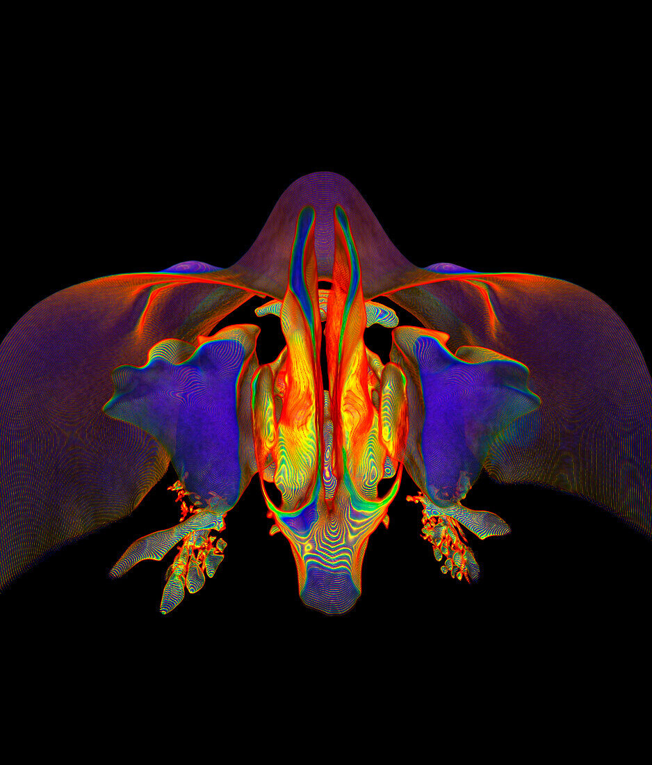 Nasal cavity and sinuses, 3D CT scan