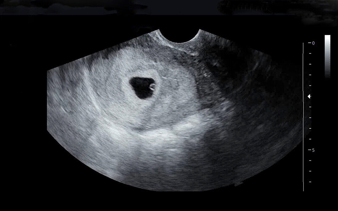 Embryo at five weeks, ultrasound scan